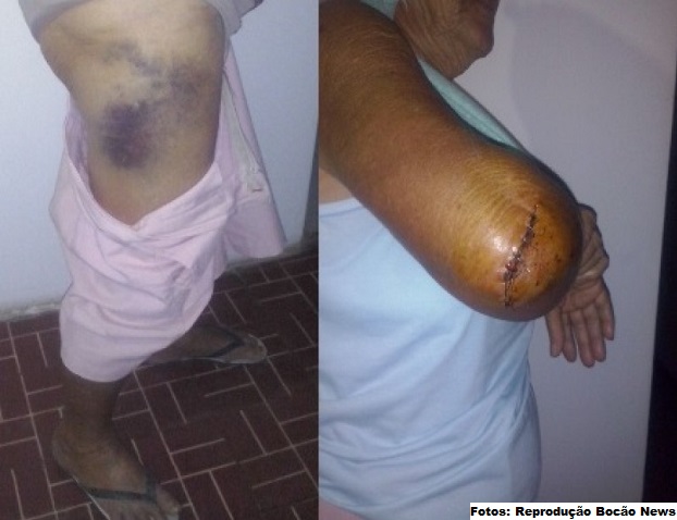 Fotos dos hematomas e cortes sofridos pela idosa na agressão